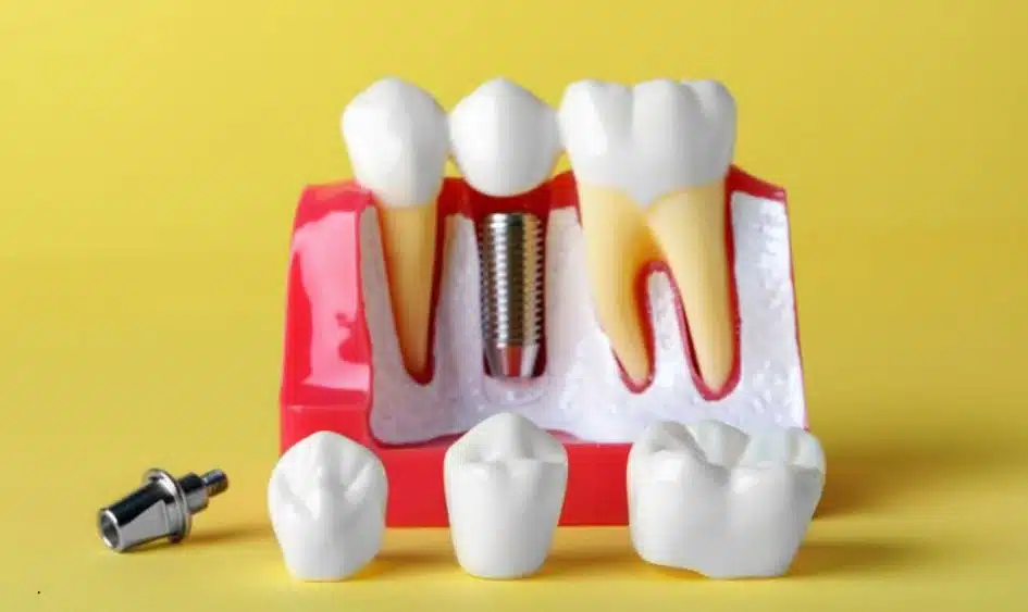 Dental implants huntsville Wikileaks 3 key differences between functional and cosmetic dental implant planning