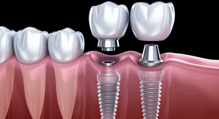 How Dental Implants Restore Confidence And Function