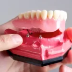 5 benefits of choosing implants over dentures or bridges