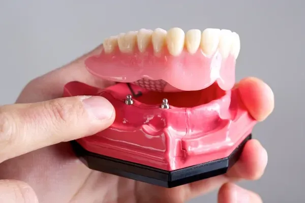5 Benefits Of Choosing Implants Over Dentures Or Bridges