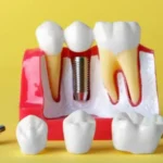 Dental implants huntsville Wikileaks 3 key differences between functional and cosmetic dental implant planning