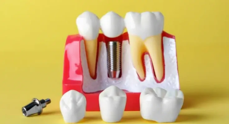 3 Key Differences Between Functional And Cosmetic Dental Implant Planning